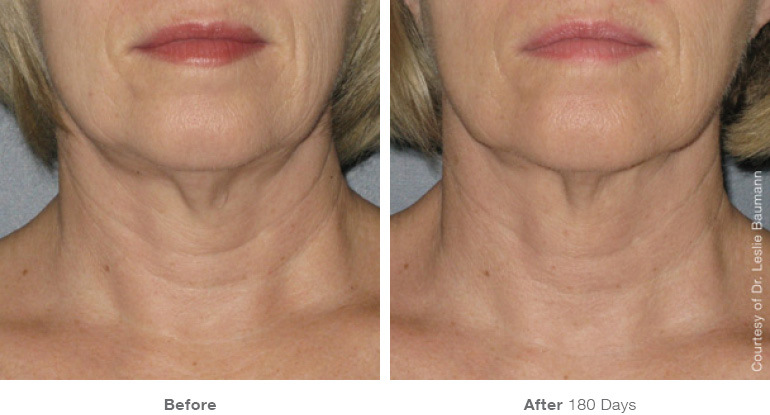 ULTHERAPY NECK